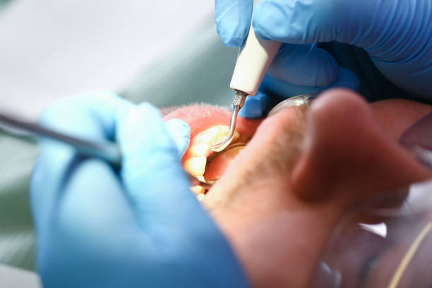 Best Emergency Treatment for Dental Infections or Abscesses in Rogersville, AL